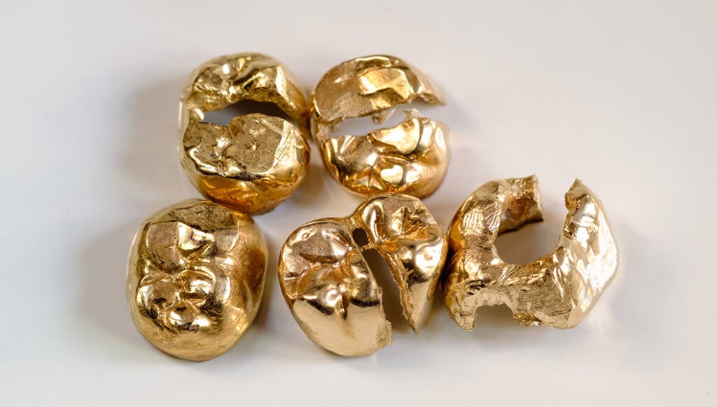 Gold Recycling: Zahngold-Kronen